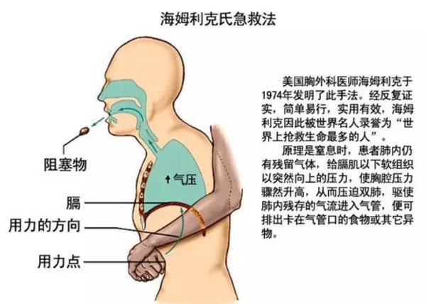 成人气管异物急救1.jpg